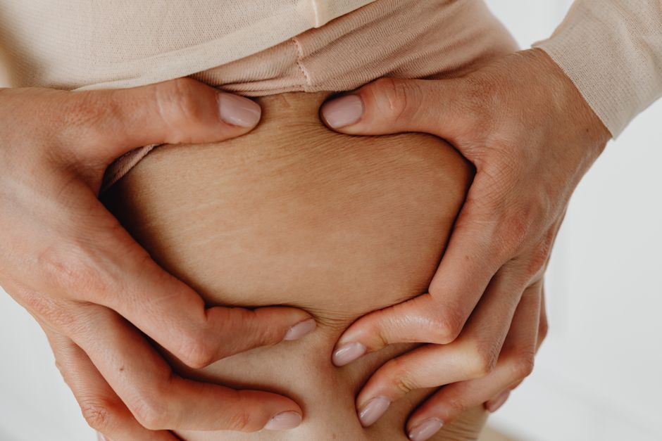 Como tratar estrias no corpo: 5 ativos que realmente funcionam