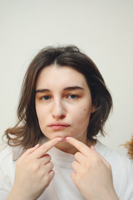 Por que a acne aparece sempre no mesmo lugar do rosto: entenda as causas e como tratar 3 mapeamento facial mostrando por que a acne aparece sempre no mesmo lugar do rosto