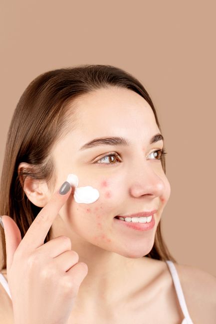 Por que a acne aparece sempre no mesmo lugar do rosto: entenda as causas e como tratar 5 mulher aplicando tratamento para acne que aparece sempre no mesmo lugar do rosto