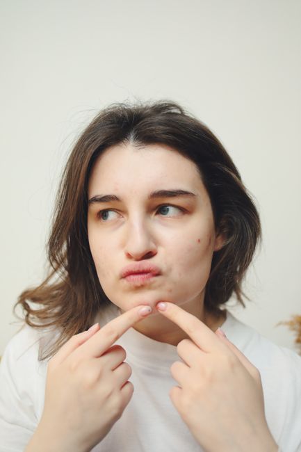 Por que a acne aparece sempre no mesmo lugar do rosto: entenda as causas e como tratar 1 por que a acne aparece sempre no mesmo lugar do rosto