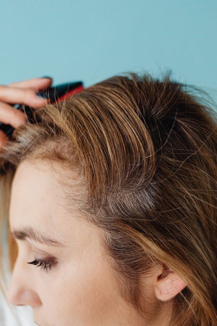 Alopecia feminina: causas, tipos e como tratar a queda de cabelo 3 Couro cabeludo feminino mostrando sinais de alopecia feminina