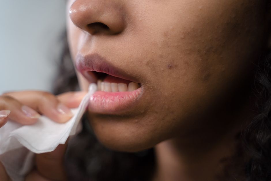 Darrow lança Actine Care para peles sensibilizadas pela acne