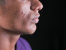 manchas pós-acne
