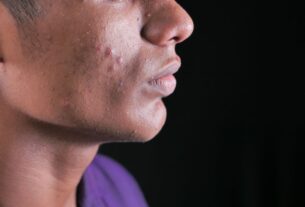 manchas pós-acne