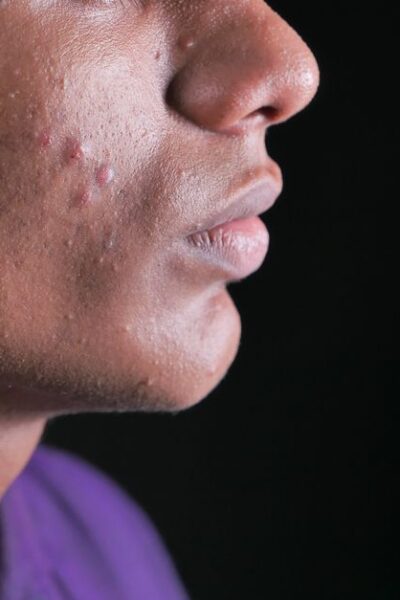 manchas pós-acne