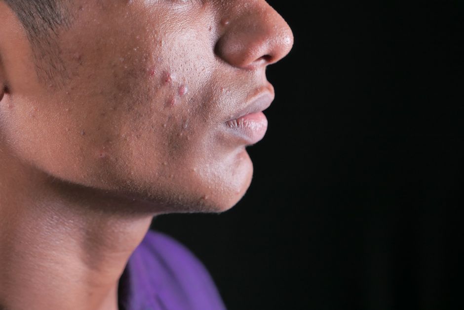 Adeus manchas pós-acne: guia prático para recuperar sua pele 1 manchas pós-acne