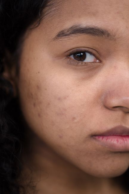 N- Manchas por Acne: Como Clarear a Mancha Pós-Inflamatória